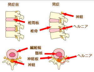 ヘルニア画像